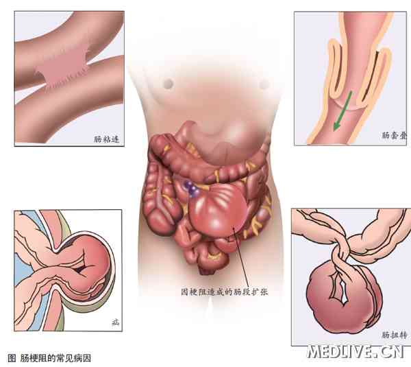 绞窄性肠梗阻为什么会引起感染性休克?-绞窄性
