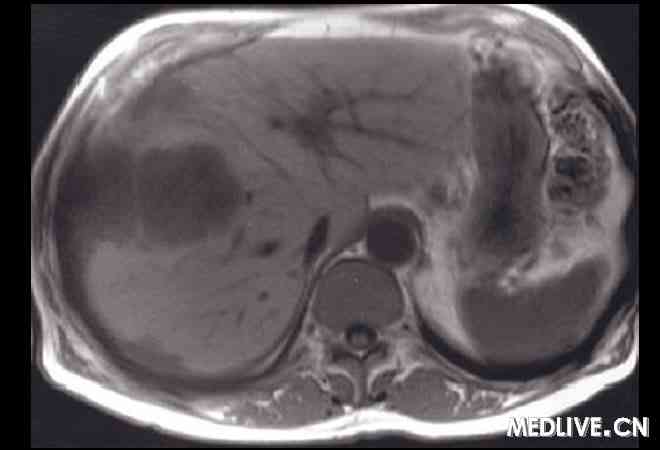 例_读片会_男,57岁,腹痛,消化不良,体重下降。