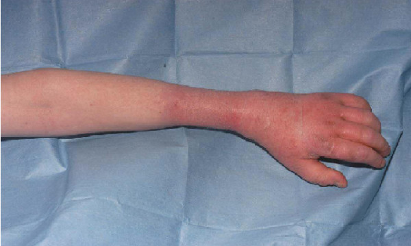 经典病例_病例报告:假性淋巴水肿作为一种精神