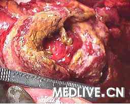 经典病例_小肠结肠 非霍奇金淋巴瘤 的同步穿孔