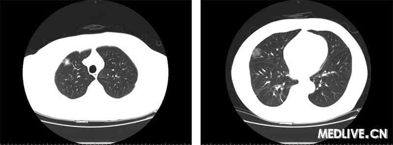 肺部结节8年--上海瑞金医院病例