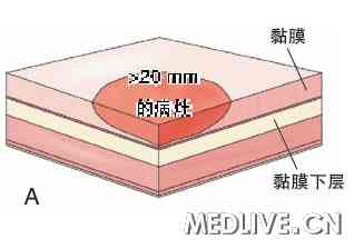 内镜治疗锯齿状结肠大息肉
