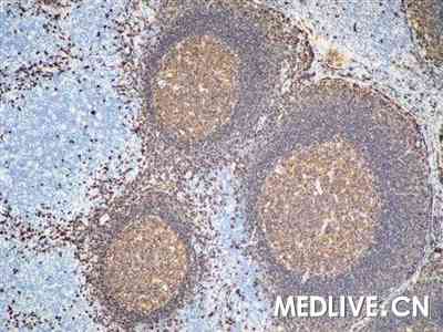 921980041_淋巴滤泡增生_淋巴滤泡_诊断_medlive.cn