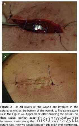 新型皮肤缝合术--全程埋入褥式缝合