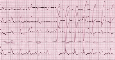 图1  置入CRT-D前，ECG示窦性心律、CLBBB、QRS间期198 ms