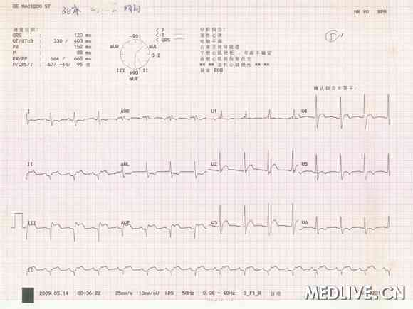 IIIIIaVFV1-V4SŢߣaVLSTѹ>1mm