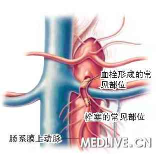 缺血性疾病:重视心脑、勿忘肠道(一)急性肠系膜上动脉缺血的诊疗 ASMAT 和ASMAE 的常见部位
