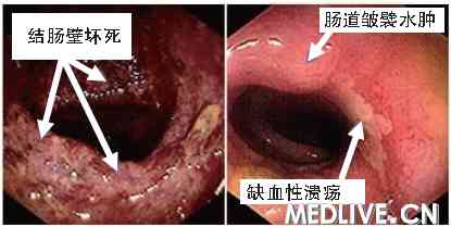  IC的结肠镜表现