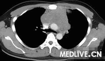 前上纵隔淋巴瘤 CT病例(图文)