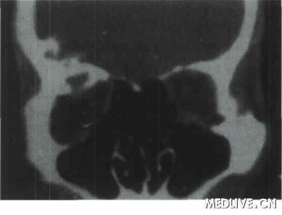 蝶骨大翼骨折ct_股骨颈骨折ct图片_蝶骨大翼骨折ct图片