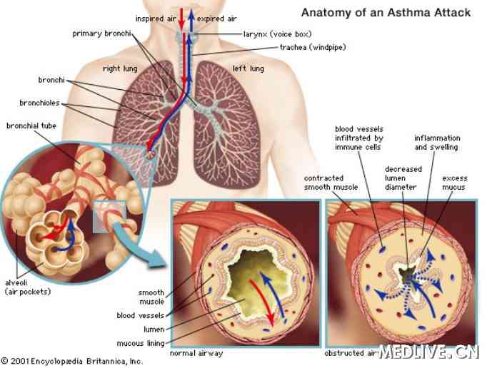 哮喘 指南 N Engl J Med.