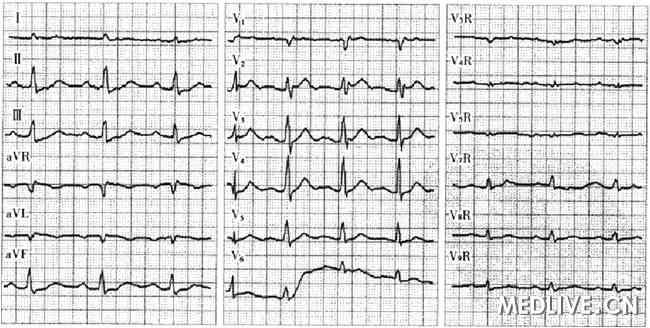CAG  ECG 心电图 心肌