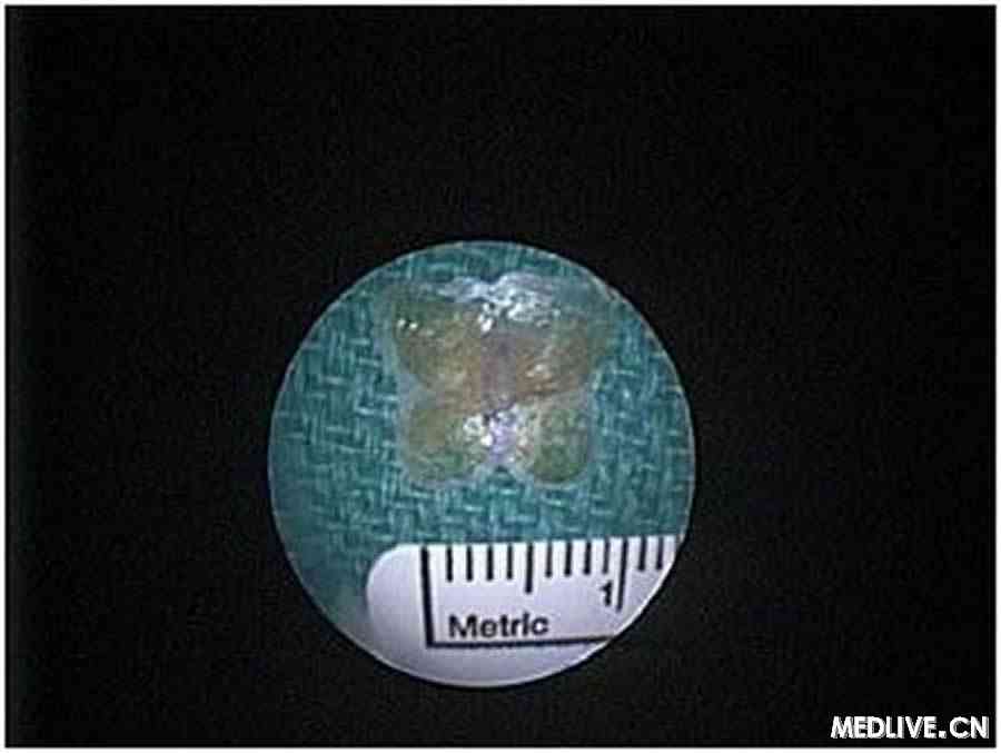  图2. 从喉部取出的蝴蝶形贴纸。该异物的直径约为1 cm。