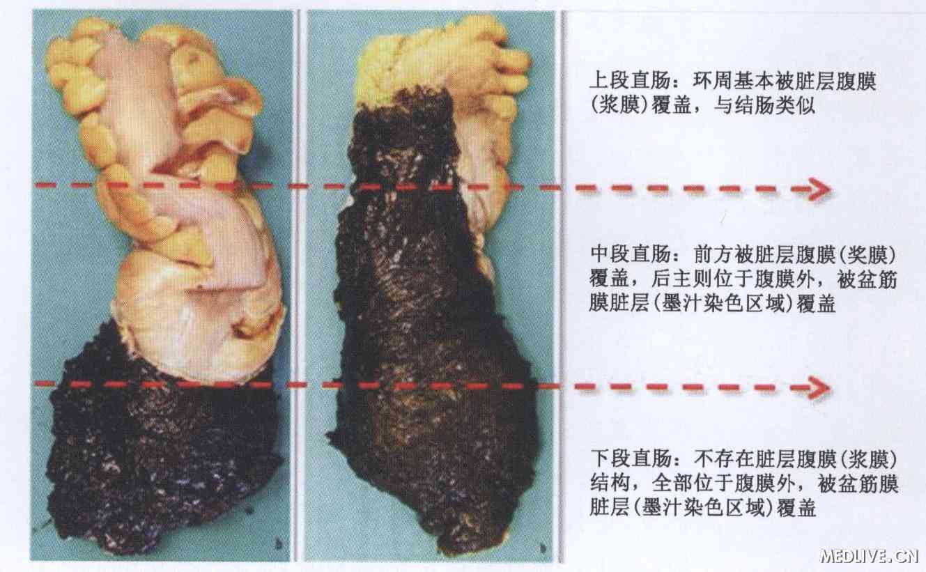 全直肠系膜切除术后标本