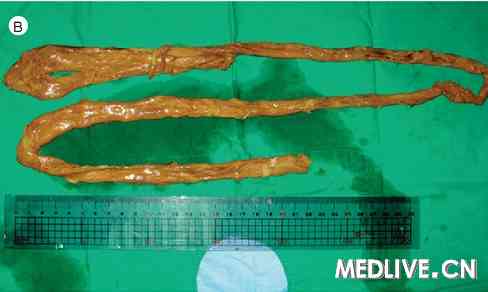 结肠管状排出_期刊文献论文免费下载