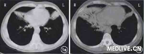 小孩一天做两次CT危害大吗