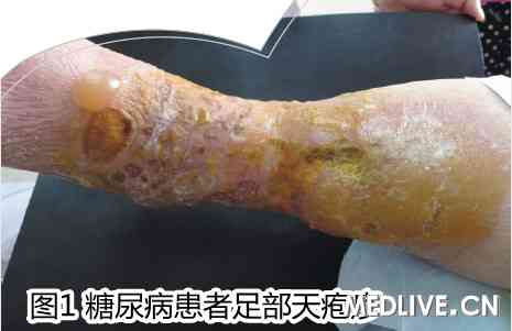 图1 糖尿病患者足部天疱疮
