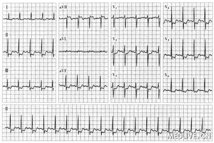 原醛误诊为不稳定型心绞痛 - 全科医疗专业讨论