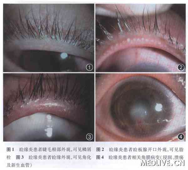 专家详解:睑缘炎及其相关角结膜病变