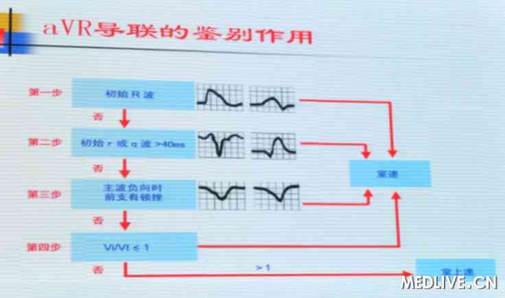 宽QRS波心动过速鉴别诊断的9个线索 |临床必