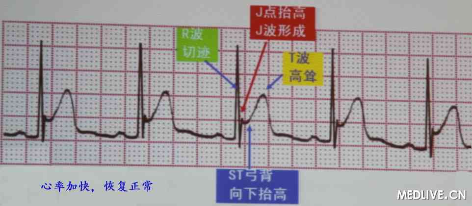 [CCCP2012]郭继鸿:早复极综合征危险分层新指