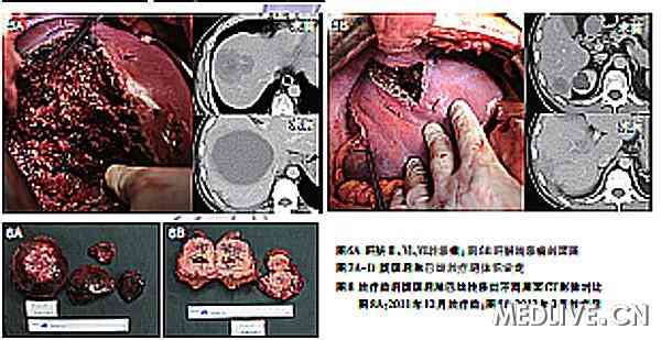 直肠癌病灶呈现等T1稍长T2信号,是什么意思