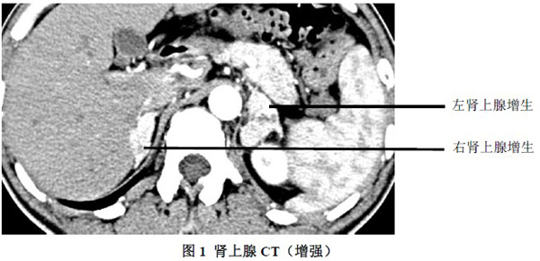 肾上腺增生新消息评论