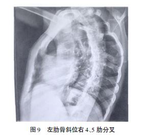 7);x 线片胸正位片左第4,5,6,7肋融合,第1-9胸椎侧弯(图8);左肋骨斜位