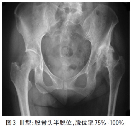 发育不良性髋关节脱位诊断,分型和手术