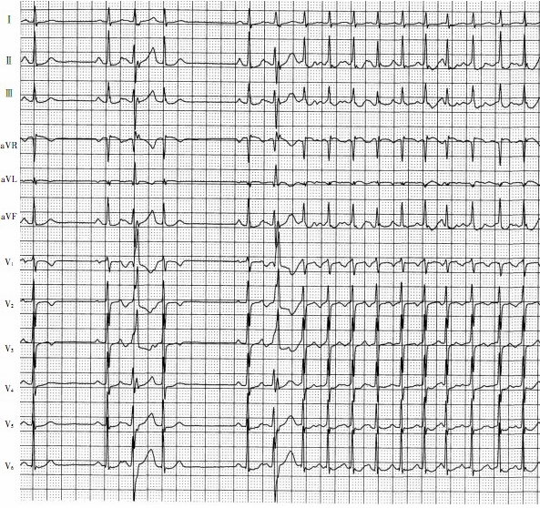 卢喜烈:P'onT房性期前收缩与心房颤动