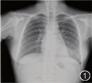 【答案公布】高热三周并肺部团块影