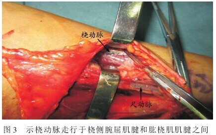 前臂中下段尺动脉走行变异