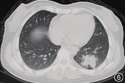 【答案公布】高热三周并肺部团块影
