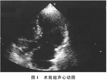 超声心动图示:左房47mm,室间隔(ivs)基底段17mm,中间段16mm,心尖段9mm