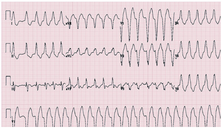 房颤遇上左束支传导阻滞,如何鉴别诊断?