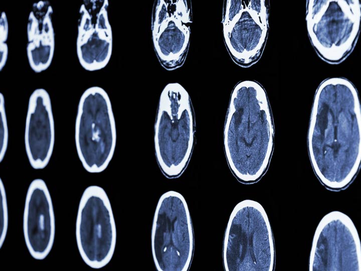 neurology:华法林相关脑出血强有力的危险因素