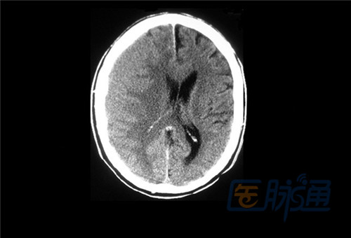 不能错过的非增强头部CT表现(图文并茂)