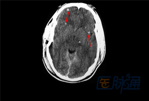 不能错过的非增强头部CT表现(图文并茂)