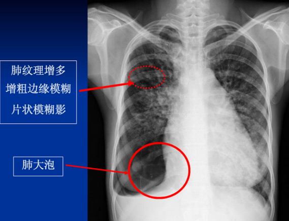 ct表现:心影增大,肺淤血,肺水肿以间质性肺水肿为著,胸腔积液 心源性