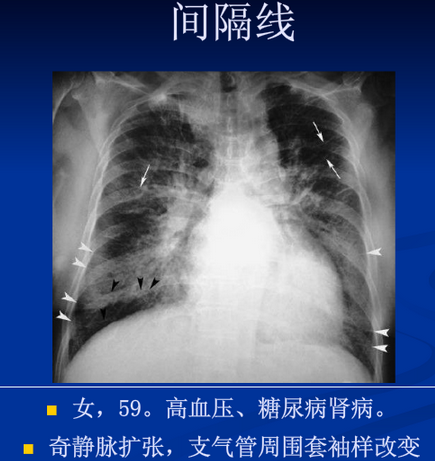 间隔线