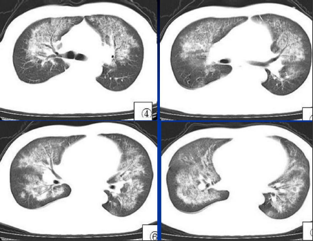 不同类型肺水肿的CT表现(下)