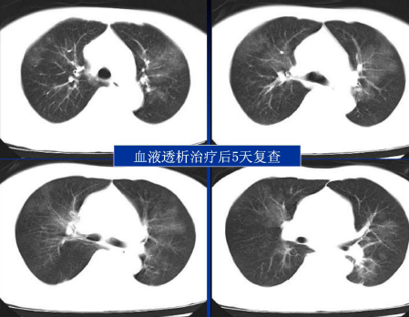 不同类型肺水肿的CT表现(下)