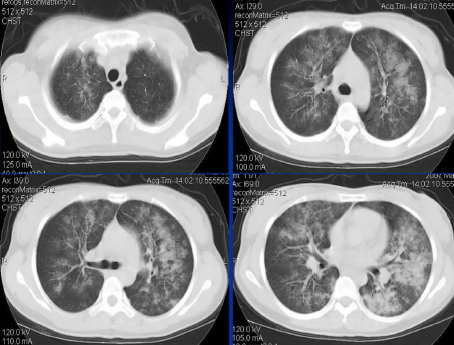 不同类型肺水肿的CT表现(下)