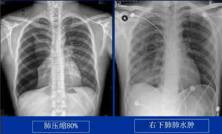 不同类型肺水肿的CT表现(下)
