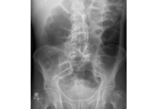 若干x光片了解肠道功能紊乱_腹部平片_肠梗阻_肠道_医
