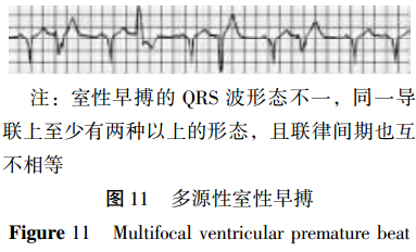 称为多源性室性早搏,其心电图表现为两种或两种以上不同形态,联律间期