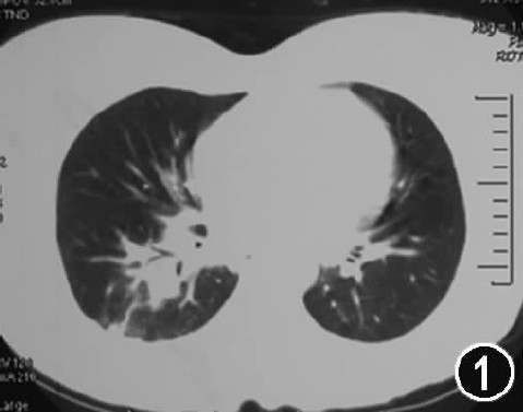 【答案公布】发热、肺部阴影、声音嘶哑