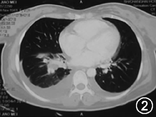【答案公布】发热、肺部阴影、声音嘶哑