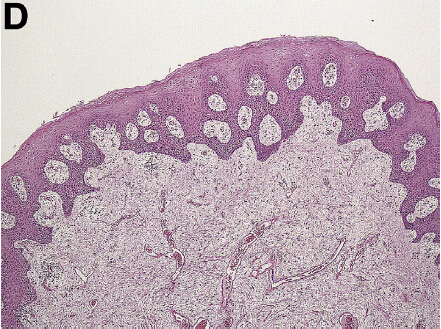 【答案公布】男,78岁,肛门异物感和里急后重,为