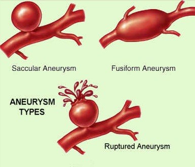 西京医院成功夹闭一例瘤壁钙化颅内巨大动脉瘤